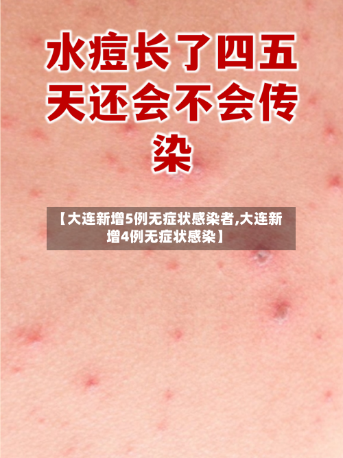 【大连新增5例无症状感染者,大连新增4例无症状感染】